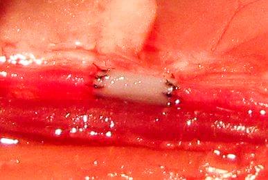 Tiny bioengineered blood vessel provides blood flow for tissue implants