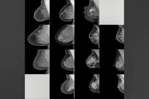 MiT Mammograms AI ICT&health